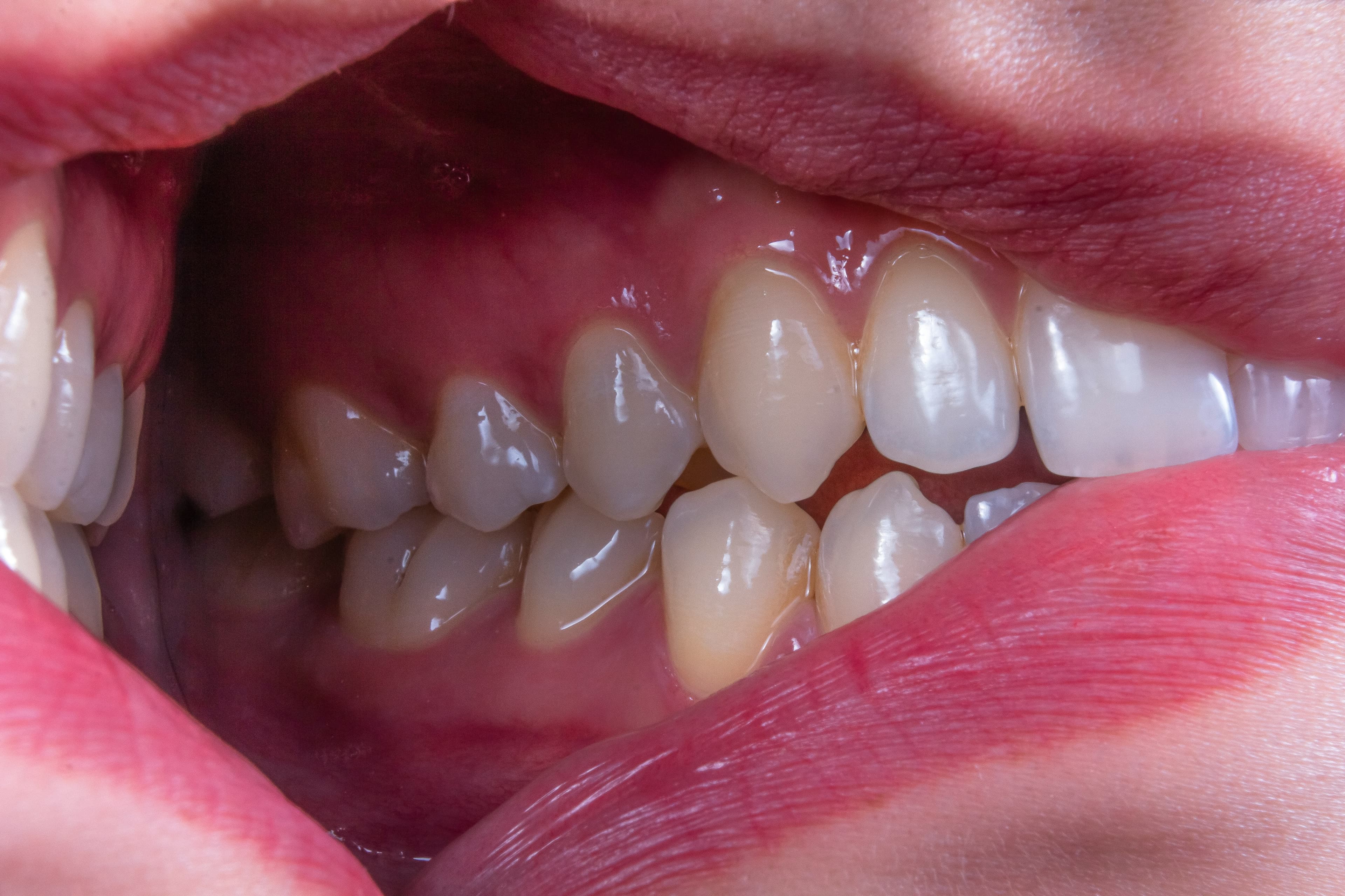 Endodoncia