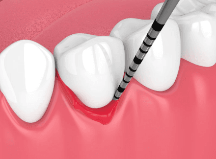 Cirugía Periodontal